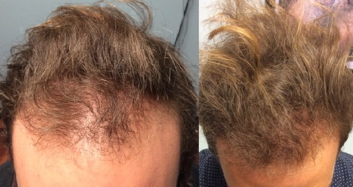 Before and After Results