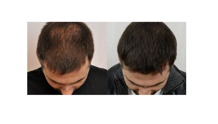 Before and After Results